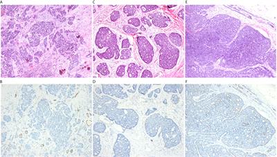 Exploration of High-Grade Transformation and Postoperative Radiotherapy on Prognostic Analysis for Primary Adenoid Cystic Carcinoma of the Head and Neck